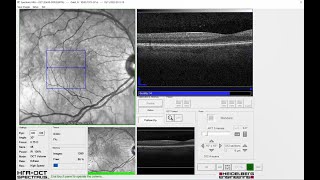 Recorded Webinar OCT LIVE Virtual Workshop  OCT Angiography Module [upl. by Ralip592]