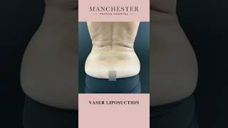 Vaser Liposuction Before and After Results by Mr Anuj Purbey [upl. by Emmi]