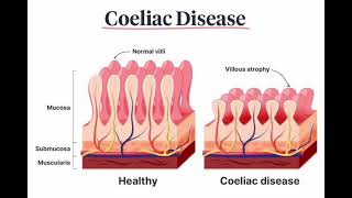 Coeliac disease mrcpch Communication [upl. by Anenahs]