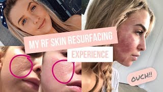 My RF Skin Resurfacing Experience [upl. by Mail]