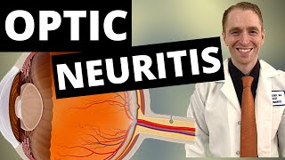 Optic Neuritis Symptoms Diagnosis and Treatment [upl. by Mateusz]