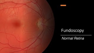 Healthy Retina Fundoscopy [upl. by Abisia997]