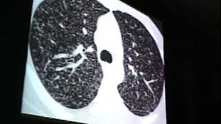 Interstitial lung disease CXR HRCT Airspace disease great [upl. by Noeht381]