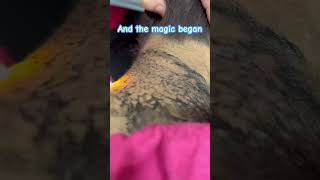 Laser treatment of hyperpigmentation skincare skintreatment viral skincaretips beautytips [upl. by Ardnuhsed]