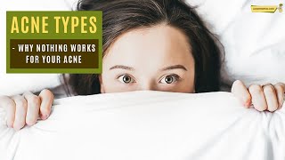 Acne types  why nothing works for my acne [upl. by Winzler]