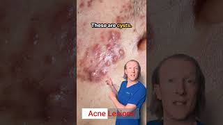 Acne Lesions White Heads Black heads Pustules Papules Cysts amp Nodules [upl. by Jobie221]