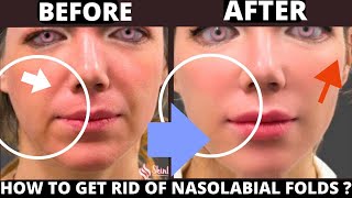 🛑 HOW TO GET RID OF NASOLABIAL FOLDS WITH FACE YOGA  LAUGH LINES JOWLS SAGGY SKIN FOREHEAD LINES [upl. by Jovitta910]