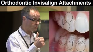 Role of Invisalign AttachmentsClear Aligner Systems in Orthodontic Treatment by Dr Mike Mew [upl. by Dnumde]