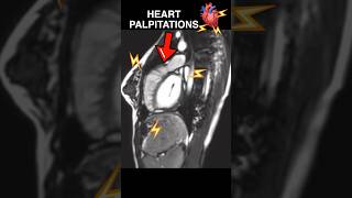 Heart PALPITATIONS under MRI🫀⚡️ anxiety cardiology [upl. by Ferdinanda]