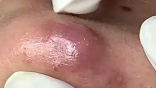 Blackheads Removal  Acne Treatment and Very Satisfying Satisfying Pimple pop blackheads [upl. by Ettennod]