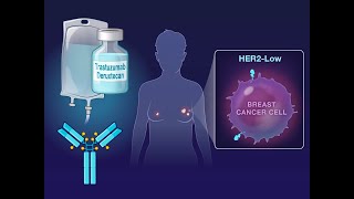 Trastuzumab Deruxtecan in HER2Low Advanced Breast Cancer  NEJM [upl. by Suellen410]