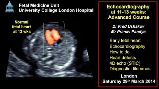 Fetal echocardiography at 1113 weeks ISUOG 2014 advanced course [upl. by Sivatco]