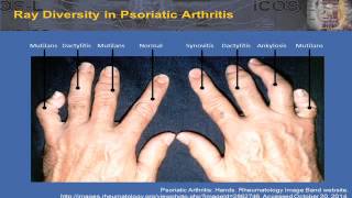 2015 Bone Immunology – Ankylosing Spondylitis and Psoriatic Arthritis [upl. by Bron430]