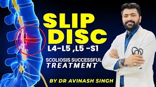 Slip disc L4L5 L5 S1 Scoliosis successful treatment treated by DrAvinash singh 9424842988 [upl. by Nadya323]