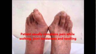 HOW TO MANAGE BUNION  Hallux Valgus both Great Toes [upl. by Ailel269]