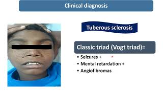 Tuberous Sclerosis  Spot Diagnosis  8  Pediatrics [upl. by Filberte]