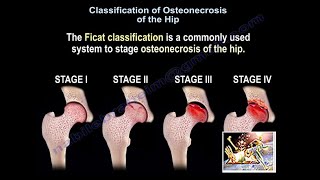 Osteonecrosis Of The Hip Ficat Classification  Everything You Need To Know  Dr Nabil Ebraheim [upl. by Pasia720]