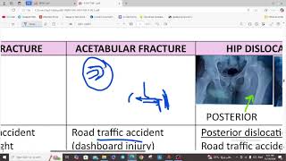 LOWER LIMB FRACTURES  ORTHOPEDICS  5TH YEAR [upl. by Uranie492]