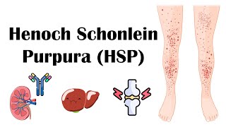 Henoch Schoenlein Purpura HSP  Causes Pathophysiology Diagnosis And Treatment [upl. by Eittel671]