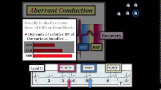 ECG Video12 Blog 113  Rhythm Diagnosis Part 3 [upl. by Ahsinej]