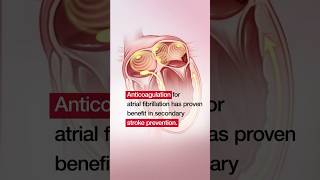 Apixaban to Prevent Recurrence After Cryptogenic Stroke in Patients With Atrial Cardiopathy [upl. by Studley763]