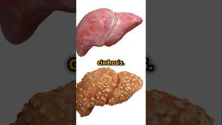 Top Causes of Liver Cirrhosis You Should Know shortvideo shortsviral shorts [upl. by Macomber]