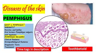 Pemphigus Vulgaris  HISTOPATHOLOGY  Immunofluorescence  Treatment  PART 22 [upl. by Chiquita114]