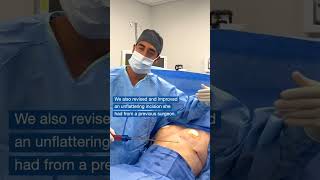 Fat Transfer to Breast with Dr Zuri in Miami  Zuri Plastic Surgery [upl. by Anica]