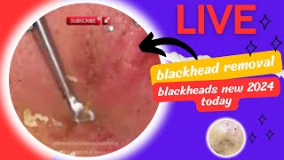 Blackheads new 2024 today blackheads extractions blackheads and whiteheads removal [upl. by Duky926]