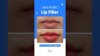 Disclosure the procedure process of Lip Filler✨ [upl. by Eenattirb]