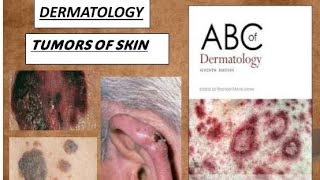 DERMATOLOGY TUMORS OF EPIDERMIS DERMIS amp MELANOCYTES PART1 benign amp malignant derma tumors [upl. by Anaihk]