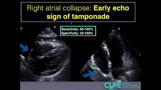 Cardiac tamponade [upl. by Christabel343]