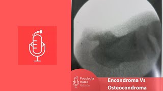 Encondroma Vs Osteocondroma [upl. by Ylrae]