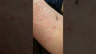 ASMR Psoriasis Flake Removal [upl. by Nai24]