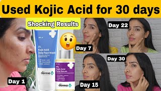 Used Derma co Kojic acid face wash and serum for 30 days 😳 Shocking Results 😨 [upl. by Ycnej602]