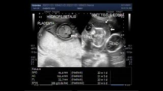 Twin Pregnancy of about 21 weeks with one fetus normal and the other with Hydrops Fetalis [upl. by Gleich]