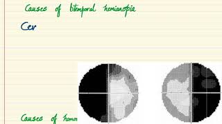 Ocular signs  Bitemporal Hemianopia and Homonymous Hemianopia [upl. by Koressa]