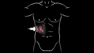 POCUS  Basic Renal Ultrasound [upl. by Stefa977]