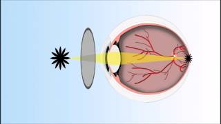 Presbyopia Explained Annimated Video [upl. by Nnylsoj]