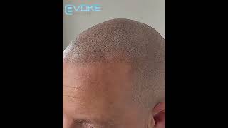 Scalp micropigmentation Get your hairline amp confidence back today [upl. by Kennett]