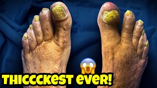 THICK YELLOW TOENAILS 🤯 [upl. by Nacnud]