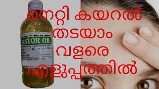 നെറ്റി കയറൽ തടയാം വളരെ എളുപ്പത്തിൽ  Netti Kayaral thadayam  Prevent Hair Fall From Forehead [upl. by Joellyn393]