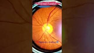 Normal fundus  Normal Retina  Smartphone Fundus Videography  Fundus Photography  Short Video 85 [upl. by Heisel]