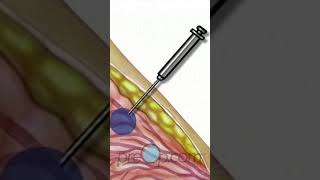 Understanding Breast Needle Biopsy 🎗️ What You Need to Know PreOp Shorts Patient Education pt 3 [upl. by Alletneuq]