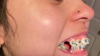 I GOT FOUR PREMOLAR EXTRACTIONS  Braces Update braces extractions adultbraces teeth vlog [upl. by Maritsa555]