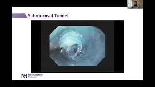 Third Space Intraluminal Endoscopy Webinar [upl. by Lowenstein]