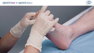 AQUACEL® Foam and AQUACEL® Ribbon Application  Diabetic Foot Ulcer [upl. by Moody]