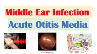 Middle Ear Infection Acute Otitis Media  Causes Symptoms Diagnosis Treatment [upl. by Sivrahc274]