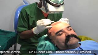 Cost Effective Hair Transplant in India Jaipur Delhi at Medispa by Dr Suneet Soni [upl. by Butch42]