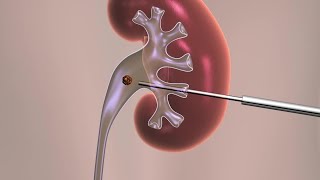 Percutaneous Nephrolithotomy [upl. by Rosenzweig]